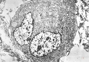 M,29y. | testis - embryonal rhabdomyosarcoma in teratoma M,29y. | testis - embryonal rhabdomyosarcoma in teratoma
